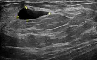 BREAST 1